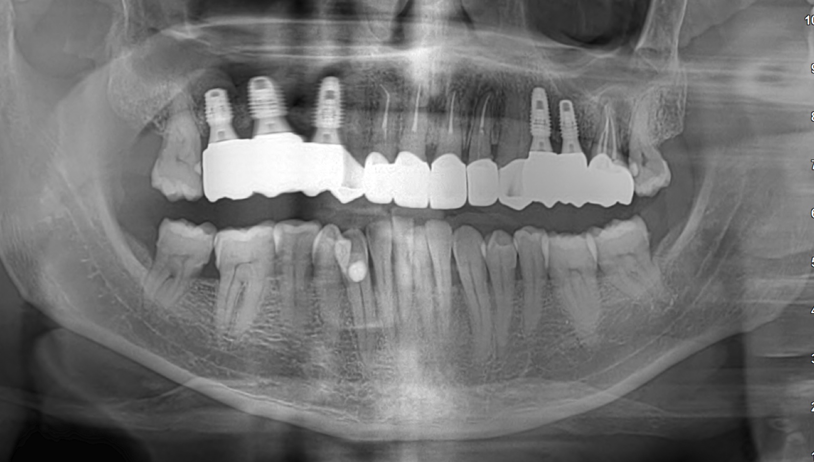 Cas 1 Intraoral After