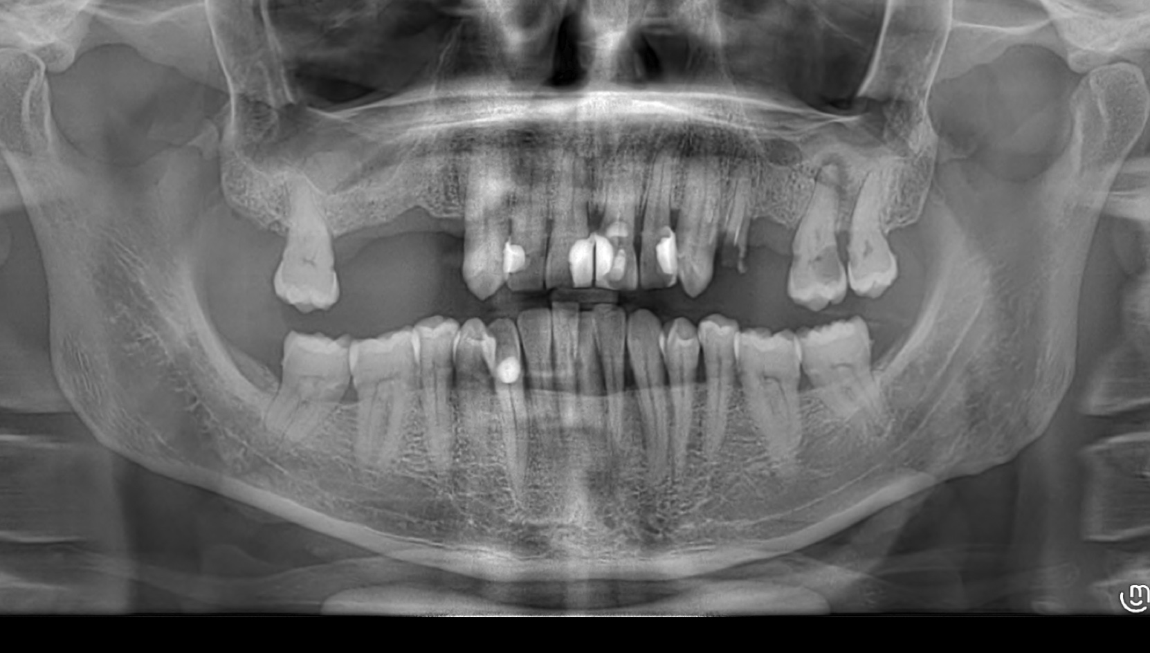 Cas 1 Intraoral Before