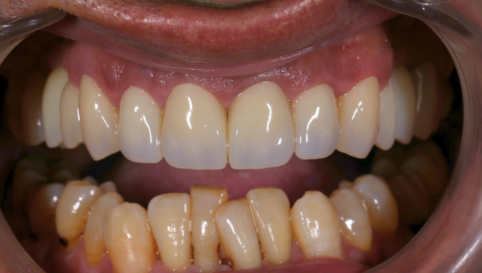 Dental case 1 X-ray after treatment