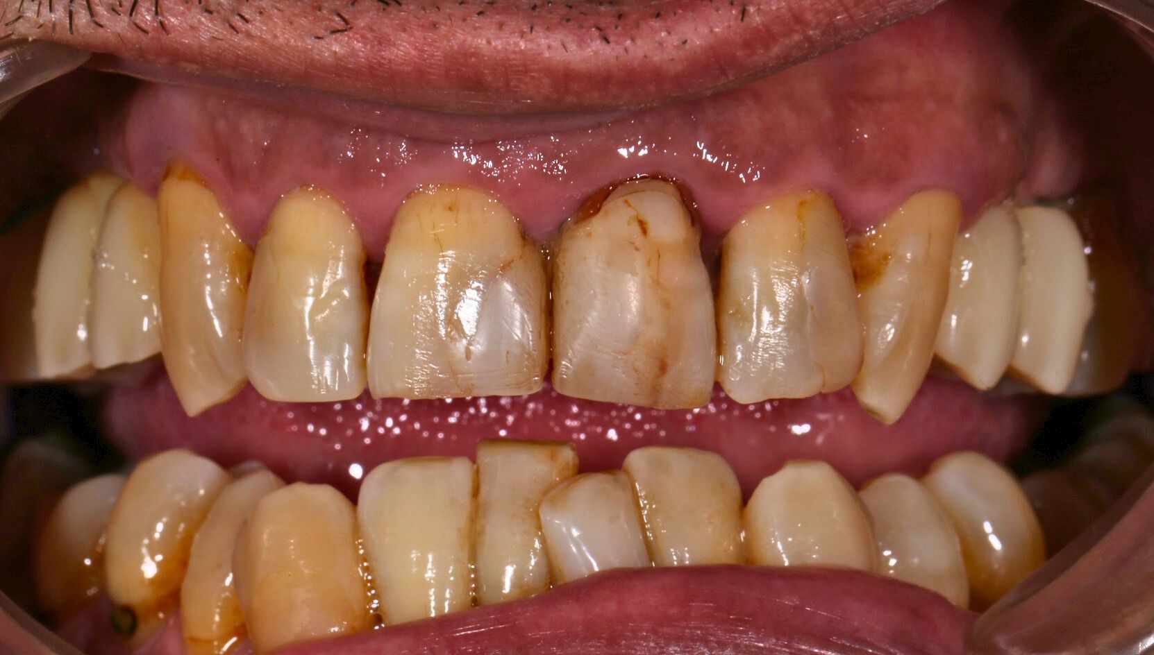 Dental case 1 X-ray before treatment
