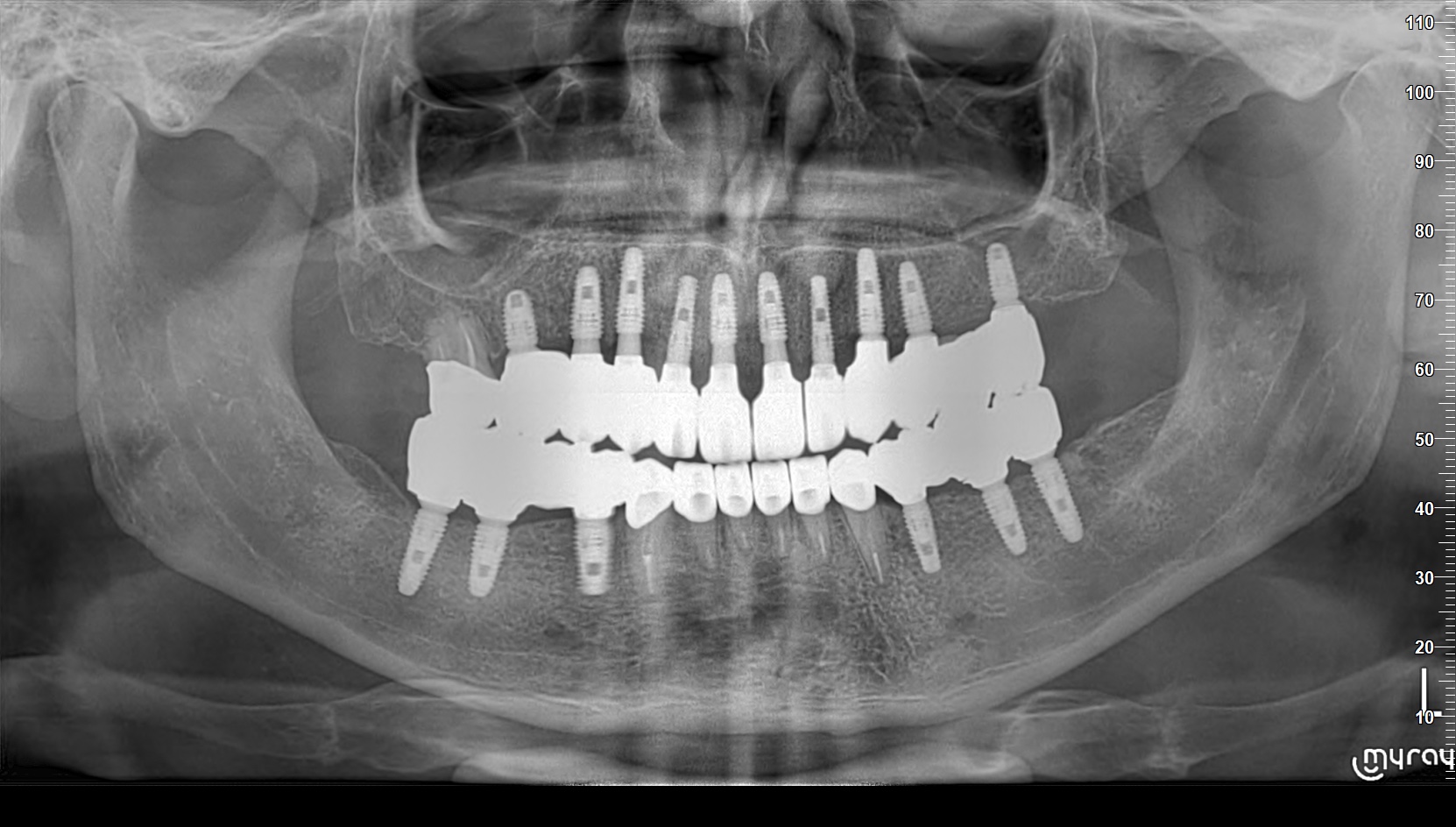 Cas 2 Intraoral After