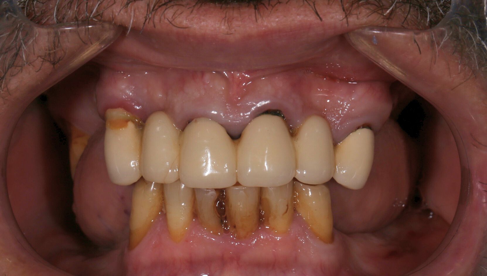 Dental case 2 X-ray before treatment