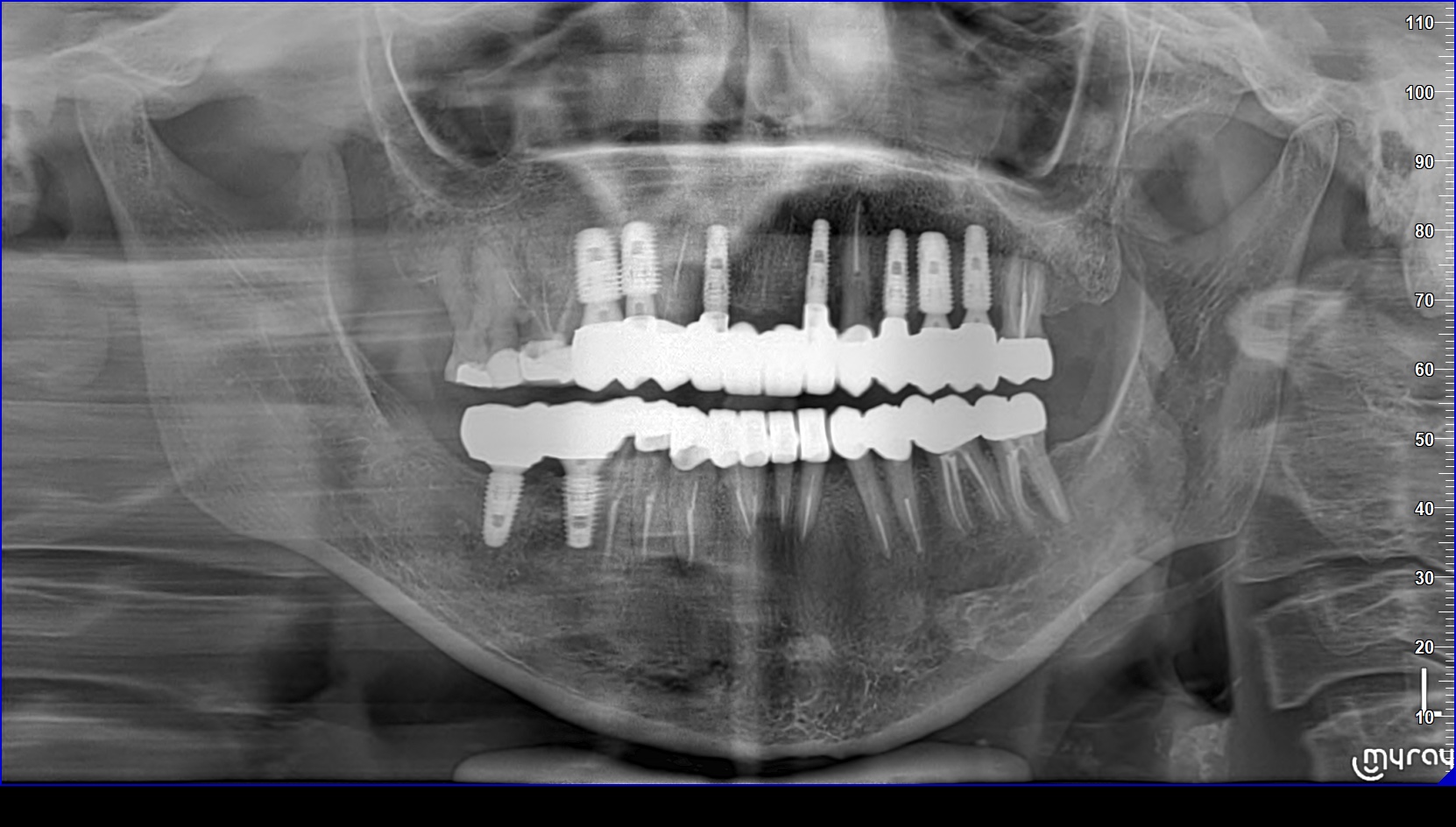 Cas 3 Intraoral After