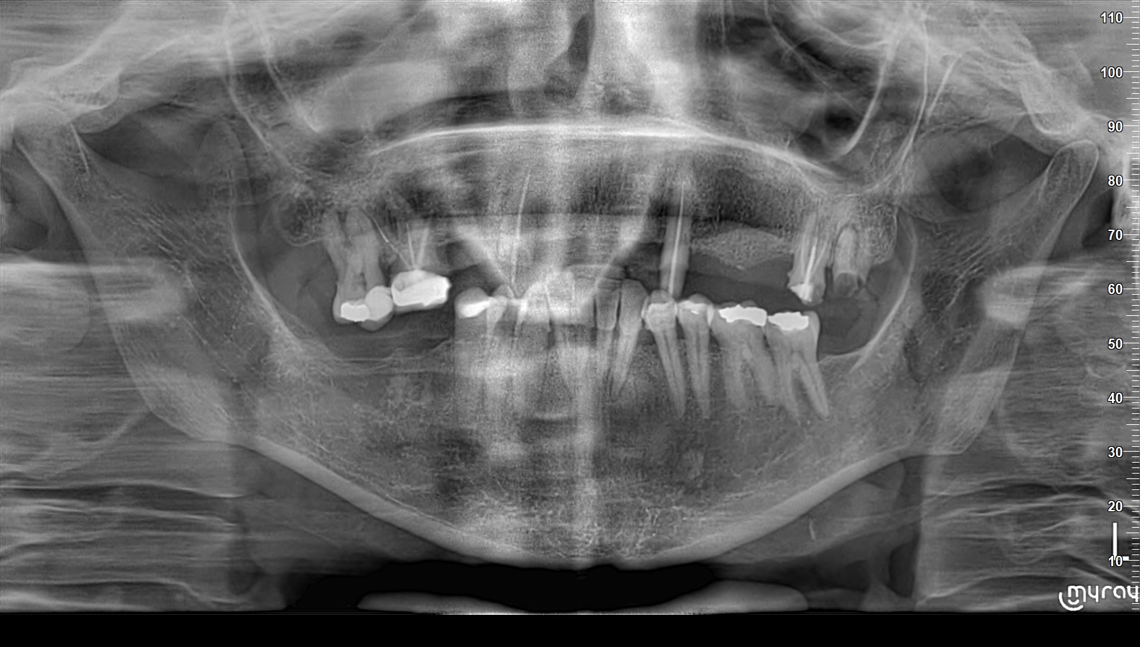 Cas 3 Intraoral Before
