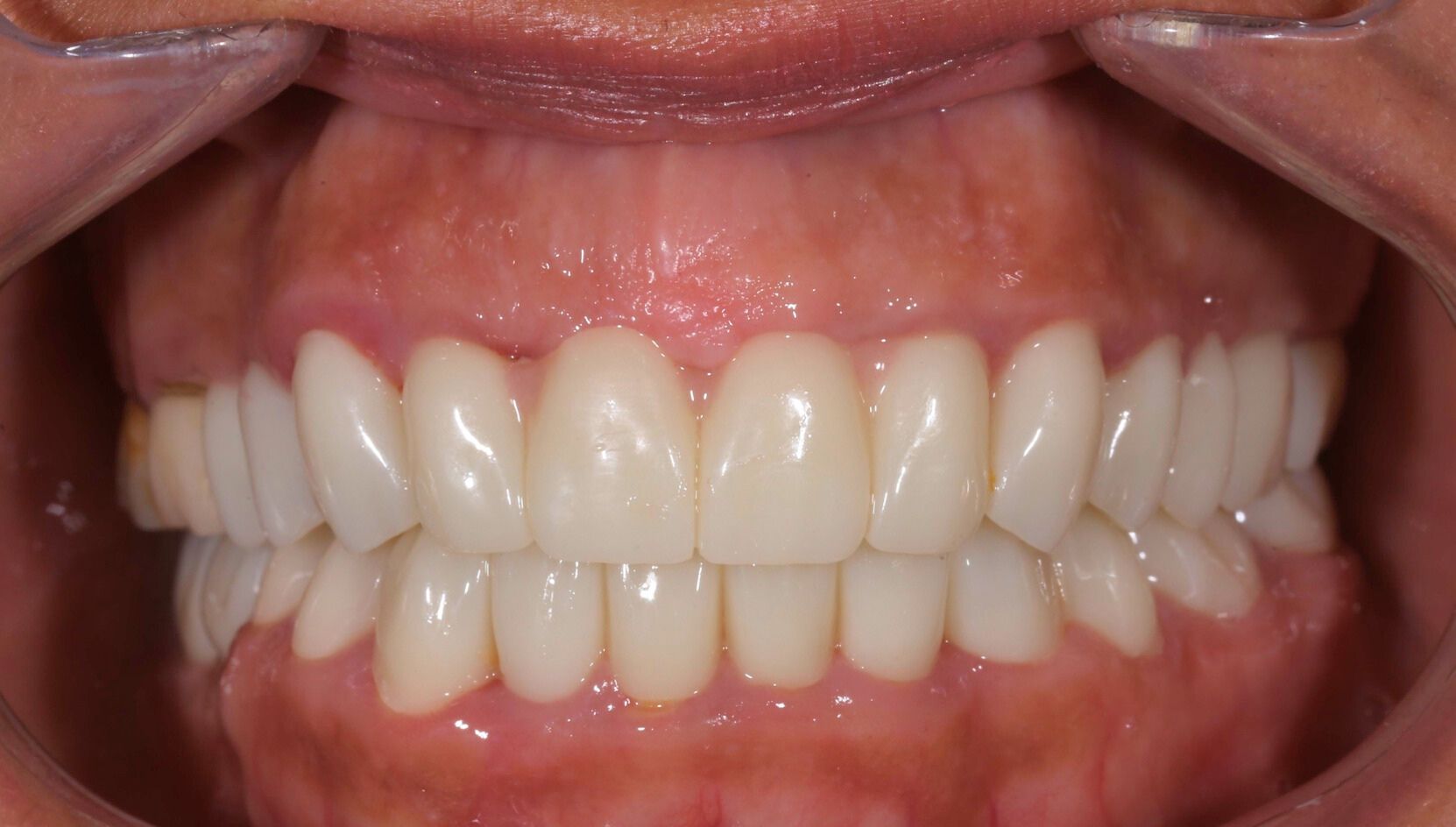 Dental case 3 X-ray after treatment