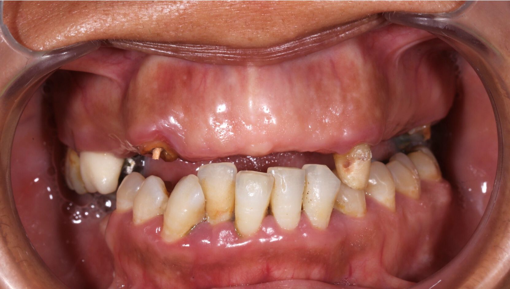 Dental case 3 X-ray before treatment