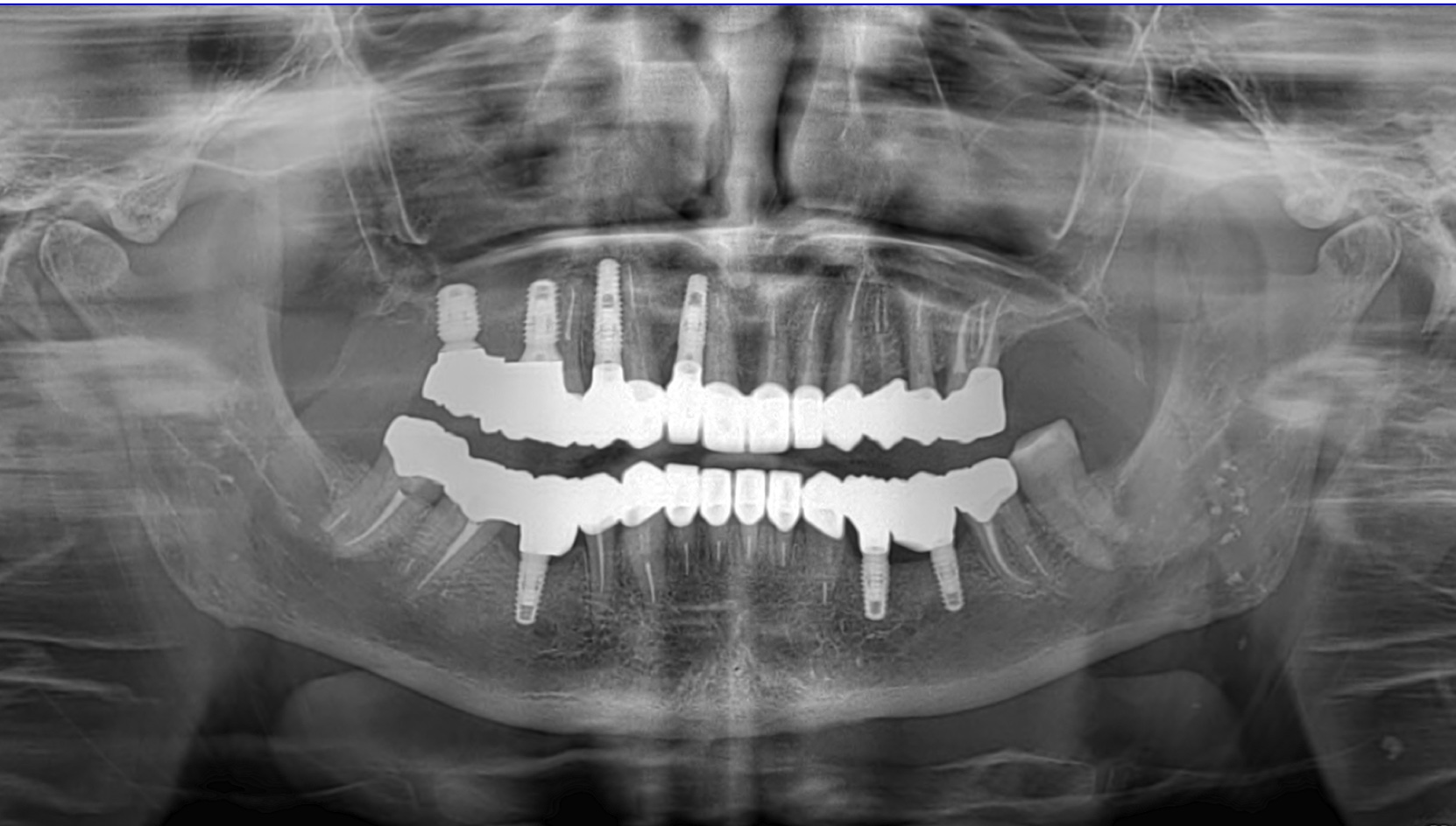 Dental case 4 after treatment
