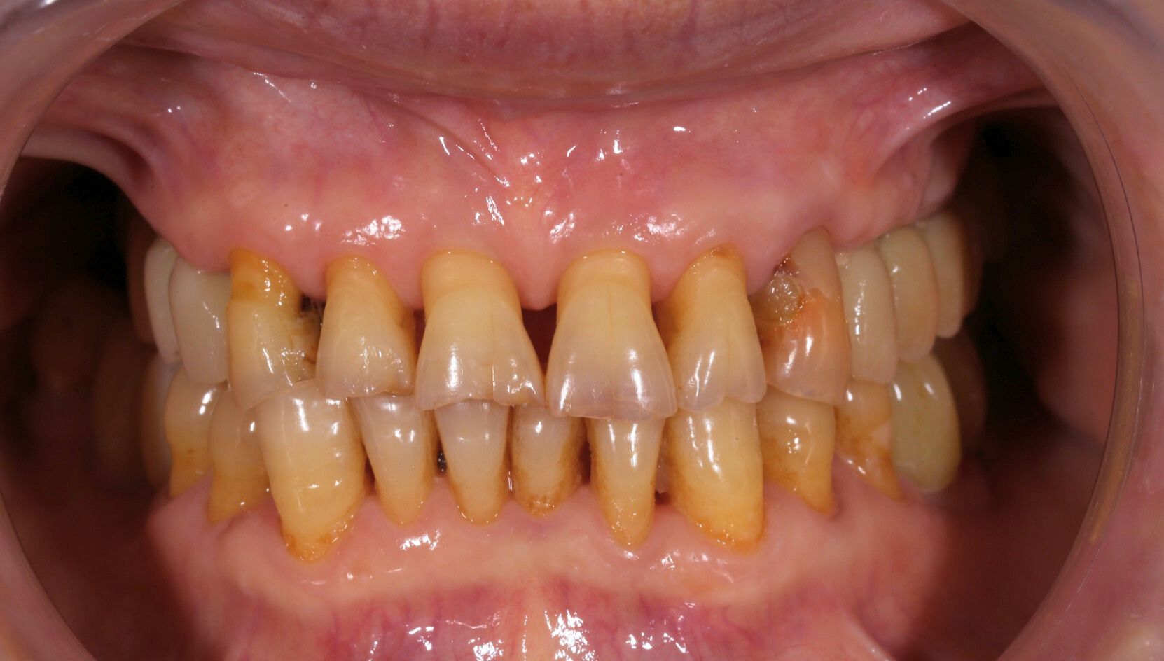 Dental case 5 X-ray before treatment