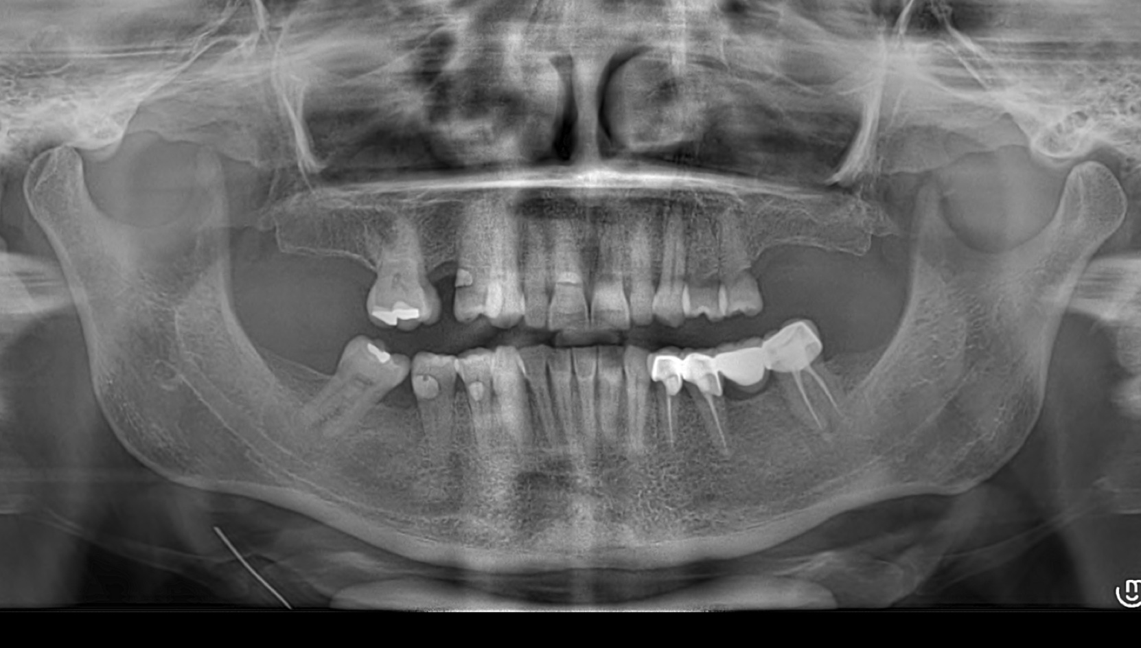 Dental case 6 before treatment