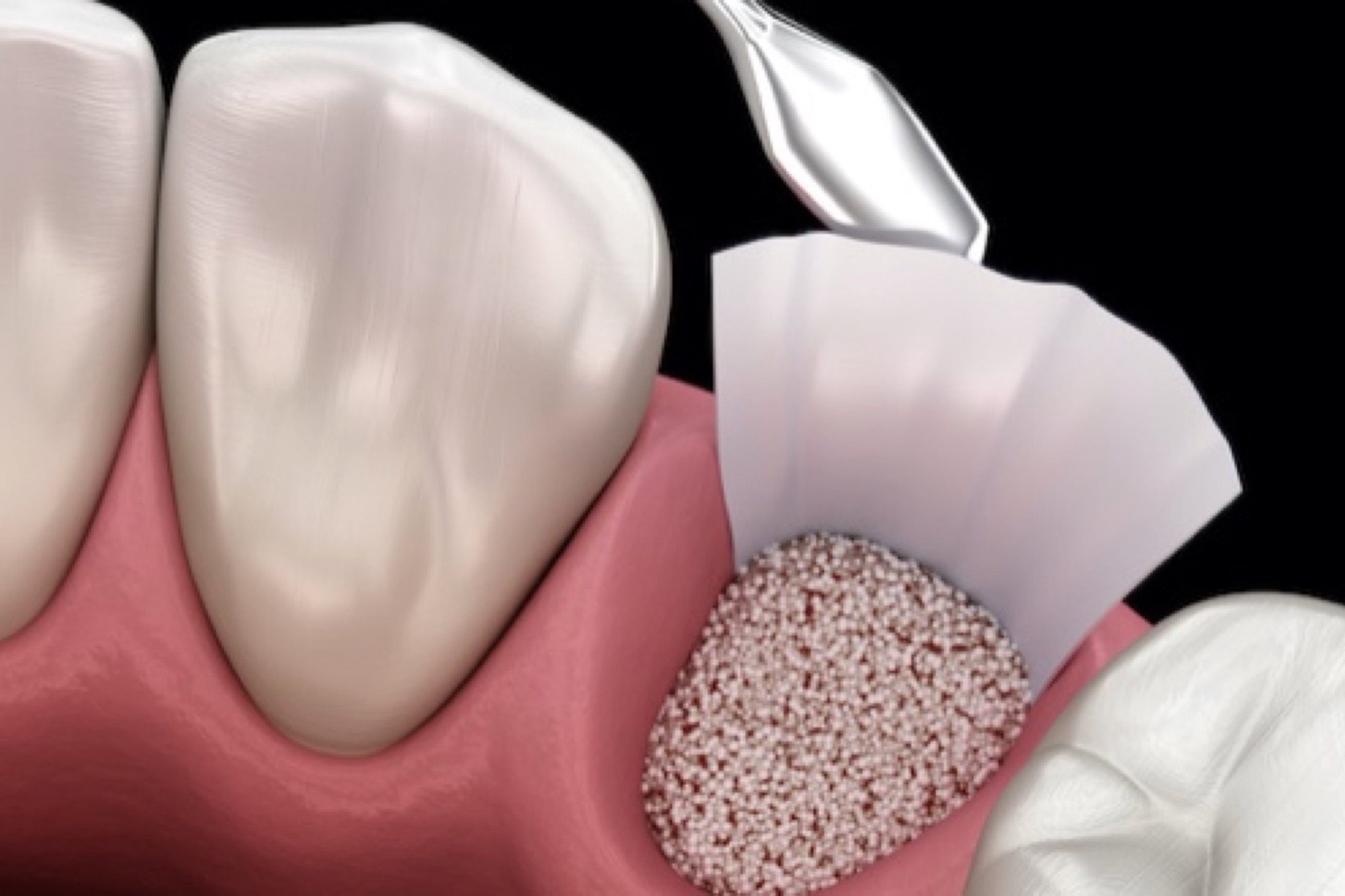 Bone Grafting